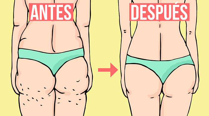 Myths and truths about cellulite and an effective method to eliminate them