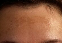 The cell can cause spots on the skin and premature aging